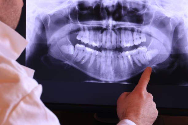 Best Emergency Wisdom Tooth Extraction in Crestwood, IL